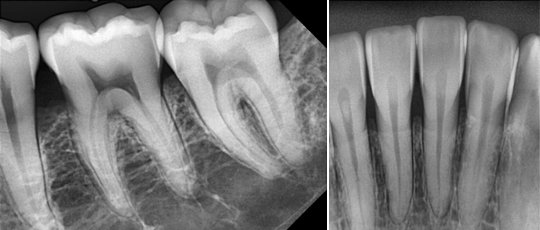 Exemples de radiographies dentaires obtenues avec EzSensor HD